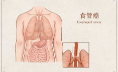 全球有一半食道癌患者在中国,探究病因与预防策略”